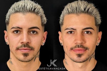 Esse e o resultado da minha harmonizacao facial que fiz na @jkesteticaavancada 😍Dr. me indicou