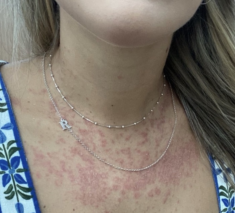 Renata Saldanha, ex-BBB, fala sobre viver com psoríase crise 1 1