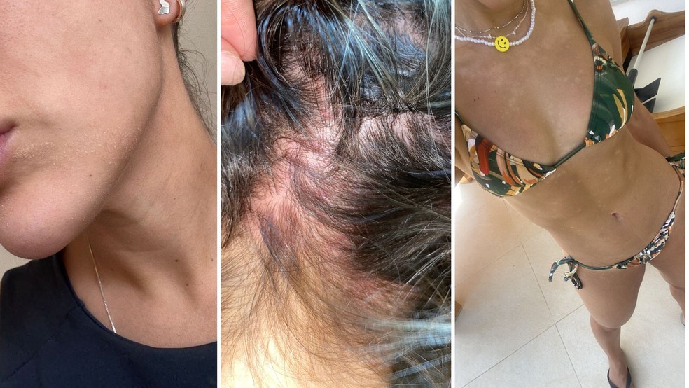 Renata Saldanha, ex-BBB, fala sobre viver com psoríase renata gshow