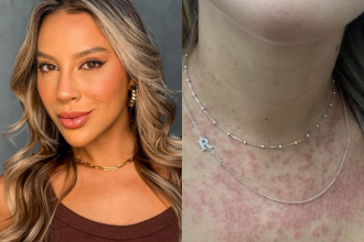 Renata Saldanha, ex-BBB, fala sobre viver com psoríase Reprodução/Instagram/@_renatasaldanha e Gshow