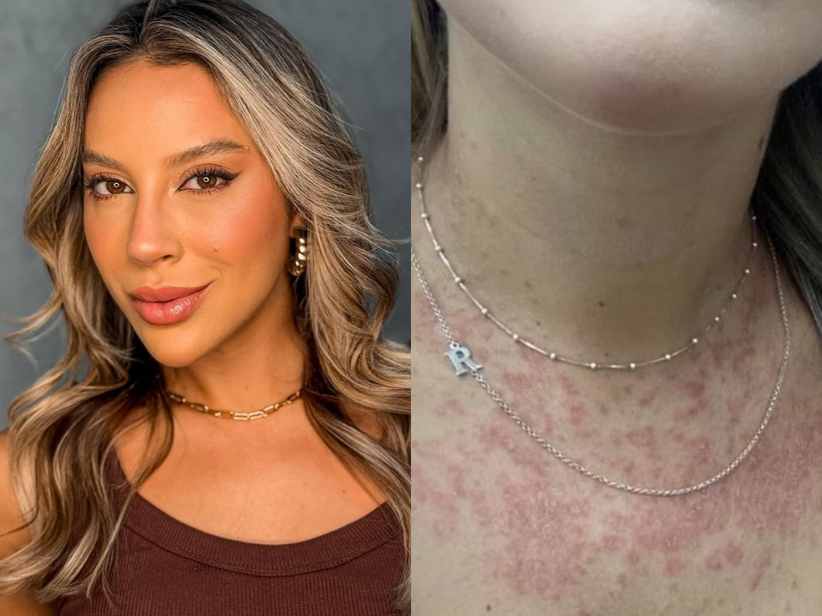 Renata Saldanha, ex-BBB, fala sobre viver com psoríase Reprodução/Instagram/@_renatasaldanha e Gshow