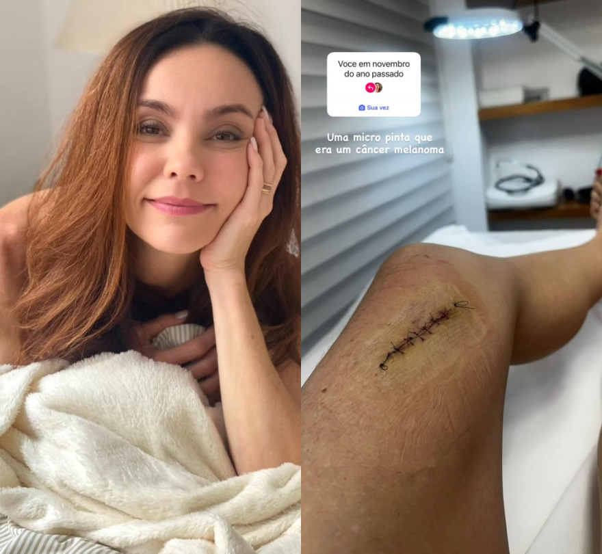 Flávia Monteiro mostra como ficou a cicatriz após retirada de tumor na perna Reprodução/Instagram/@flaviamonteiro