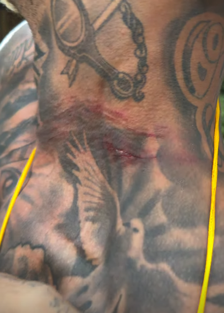 MC Cabelinho relata tentativa de assalto e mostra pescoço machucado Foto: Reprodução/Instagram/@mccabelinho