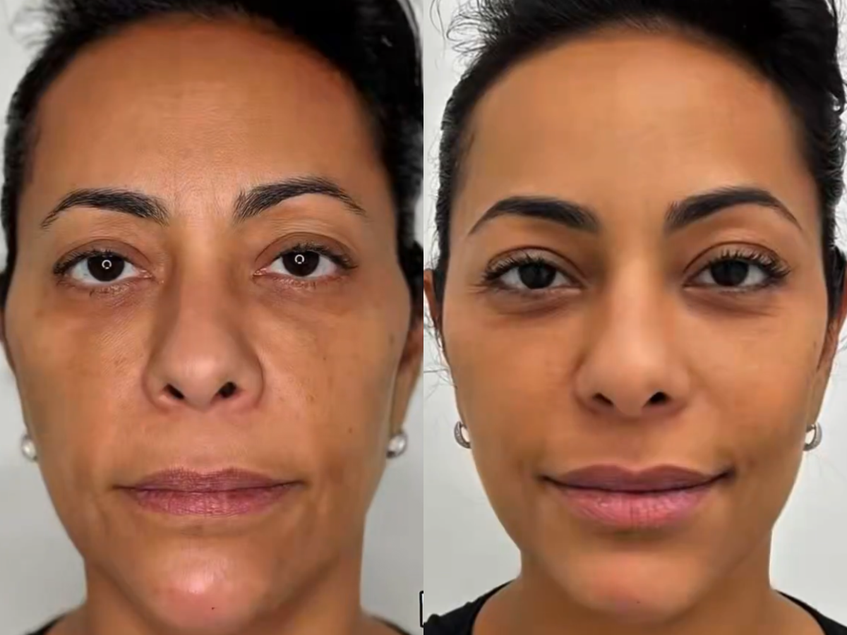 Samantha Schmutz surpreende fãs após transformação com médico das Kardashians Design sem nome 2025 12 09T104617.221